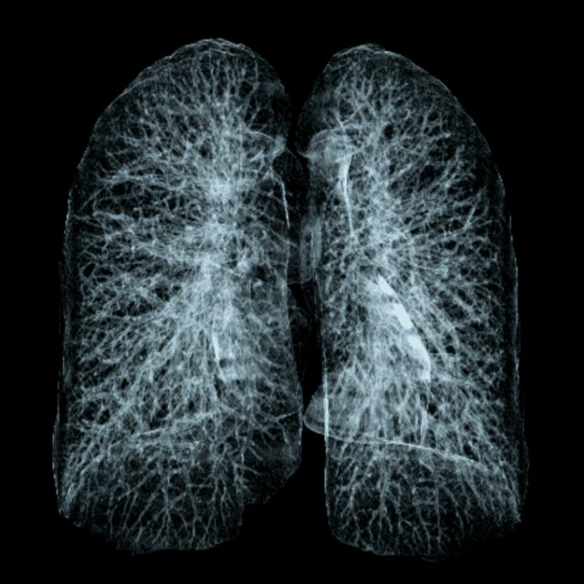комп'ютерна томографія легень